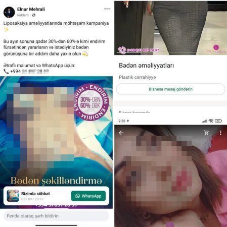 Sertifikatı olmasa da, özünü plastik cərrah kimi reklam edir: Elnur Mehrəli qanunu saymır? - DƏLİXANADIR, VALLAH...